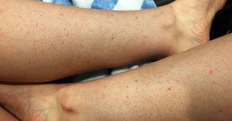 Was verursacht Erdbeerbeine und wie man sie loswird