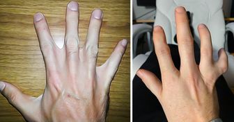 16 Menschen, die ein kleines Geschenk der Natur an ihrem Körper haben