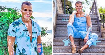 Nachdem er seine Vitiligo 10 Jahre lang versteckt hat, zeigt dieses 37-jährige Model nun stolz sein Gesicht, um andere zu inspirieren