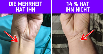 10 Seltsame körperliche Merkmale, die den Betroffenen zu einer Ausnahme von der Regel machen
