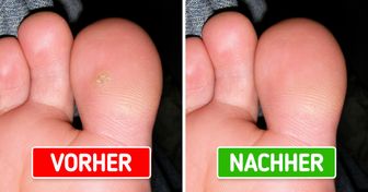 8 Wege, Warzen auf natürlichem Weg loszuwerden