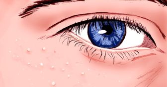 Was sind diese weißen Pickel um die Augen und warum sollten wir nicht versuchen, sie zu entfernen?