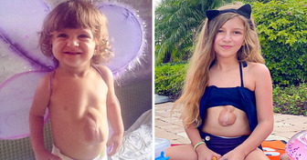 Das wunderbare Mädchen, das mit einem Herzen geboren wurde, das außerhalb der Brust schlägt