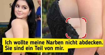 10 Stars, die zu ihren “Makeln” stehen und auch uns inspirieren, stolz auf unsere Schönheitsfehler zu sein