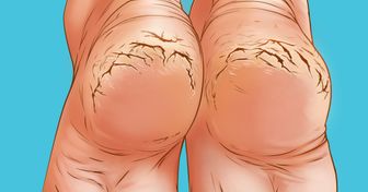 Warum deine Fersen einreißen und wie du sie behandeln kannst