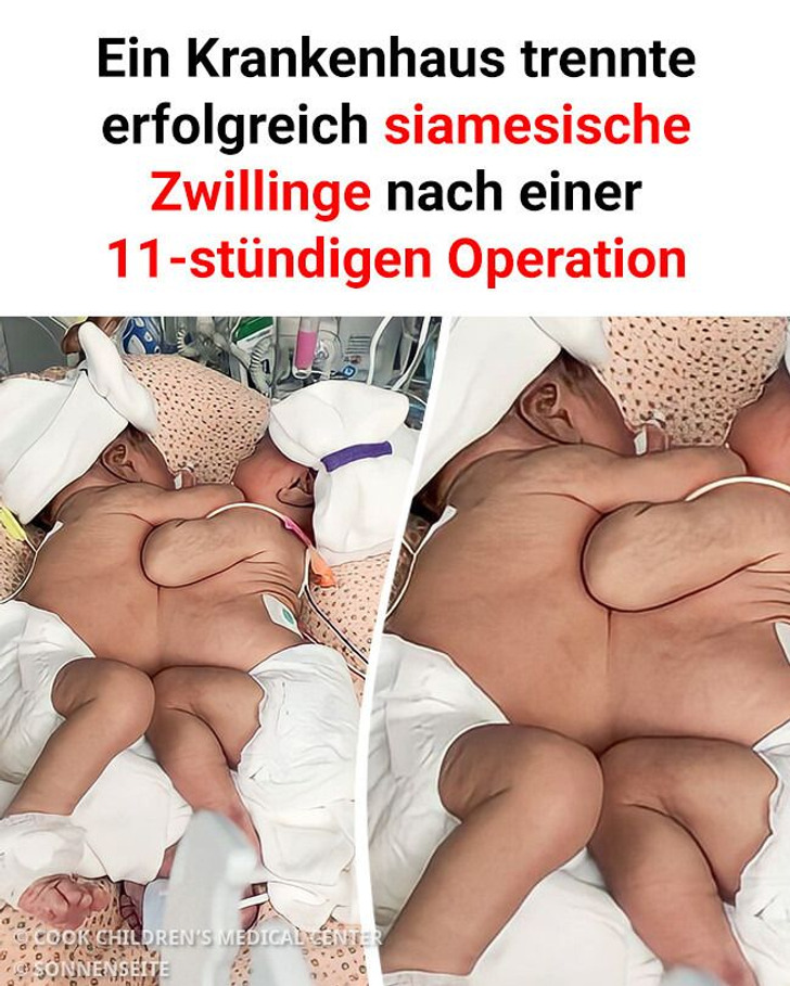 Ein Krankenhaus trennte erfolgreich siamesische Zwillinge nach einer 11-stündigen Operation