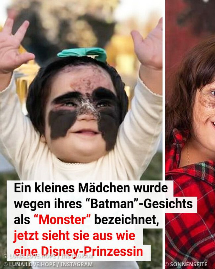 Ein kleines Mädchen wurde wegen ihres “Batman”-Gesichts als “Monster” bezeichnet, jetzt sieht sie aus wie eine Disney-Prinzessin